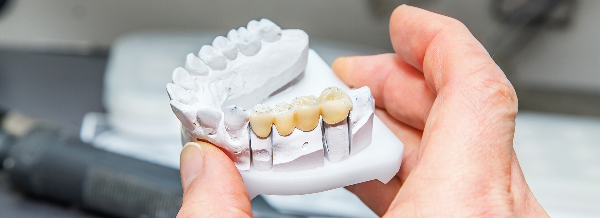 The image shows a person holding a dental model with missing teeth, examining it closely.