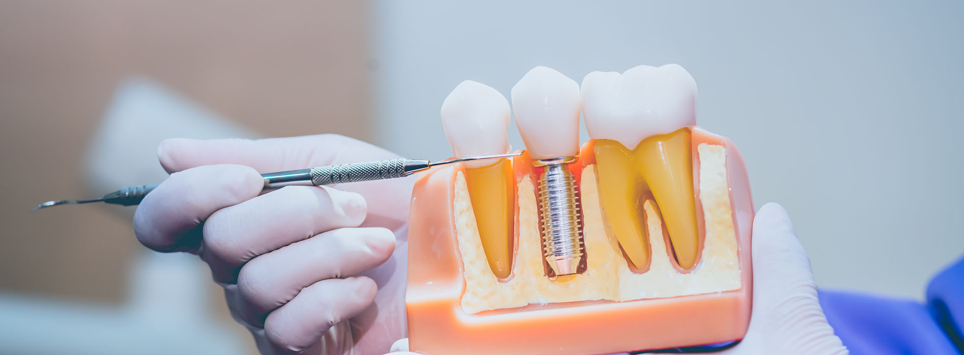 The image shows a close-up of a dental drill with a tooth being worked on by a dentist's hand, with a focus on the drill and the tooth, and there are visible orange dots that could represent areas of decay or areas to be treated.