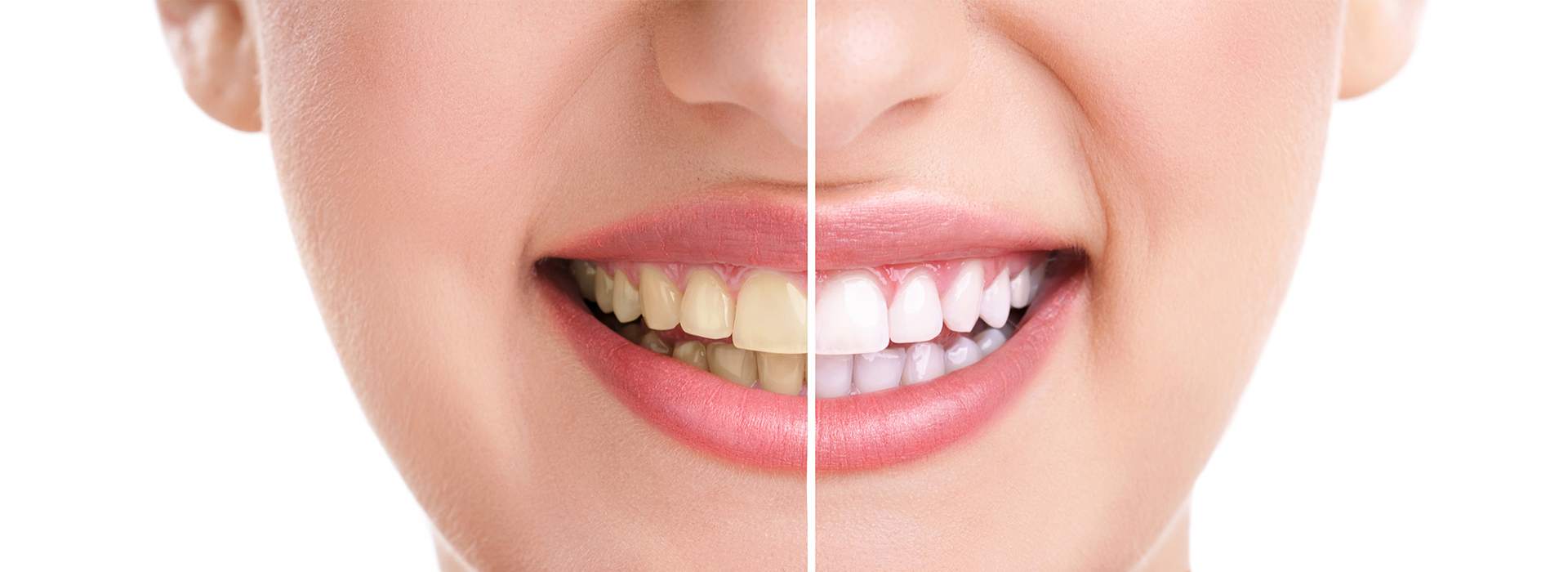 The image shows a close-up of a person's face with a large smile, featuring white teeth and pink lips, against a white background.