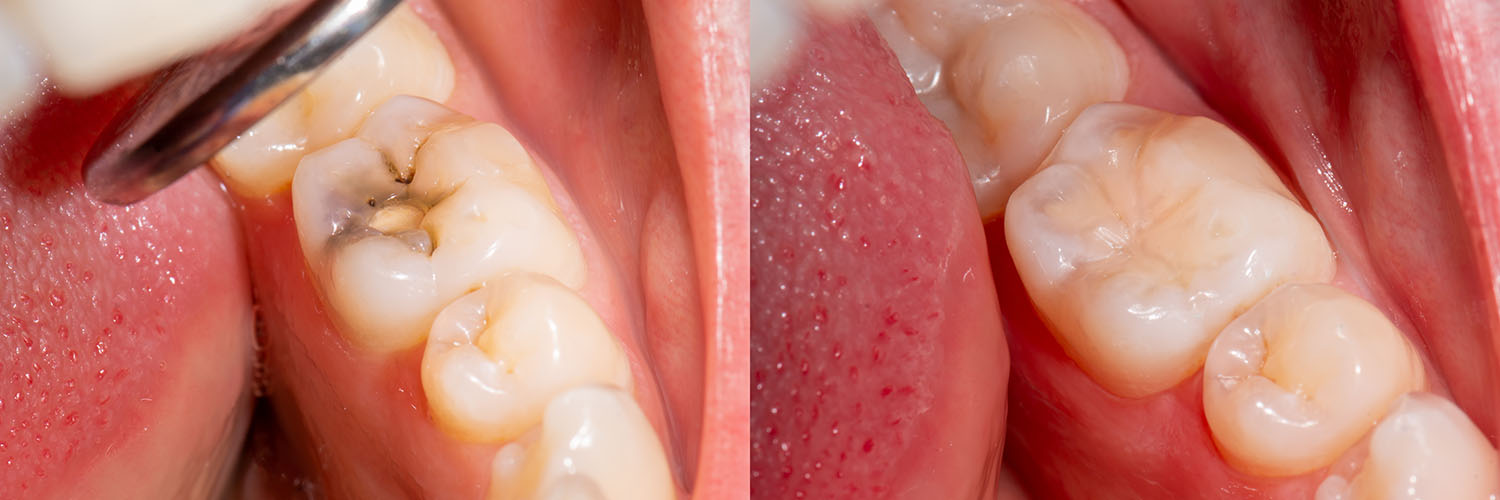 The image shows a close-up view of a person s teeth with missing enamel and gum disease, featuring an up-close perspective on dental health issues.