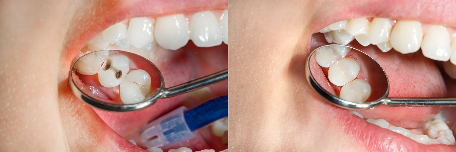 The image displays a person s open mouth with a dental mirror and toothpicks, showcasing their teeth and gums, with two different views of the same scene for comparison.