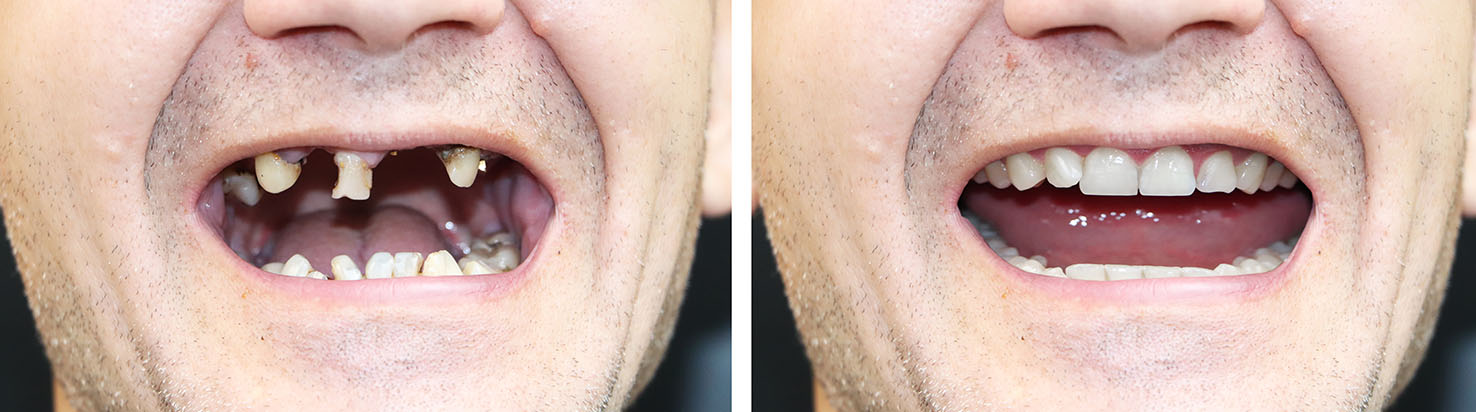 The image shows a person with two different facial expressions side by side, captured in a split-screen format, with an  alt  tag description that reads   A man with two contrasting facial expressions, one showing teeth and the other not.