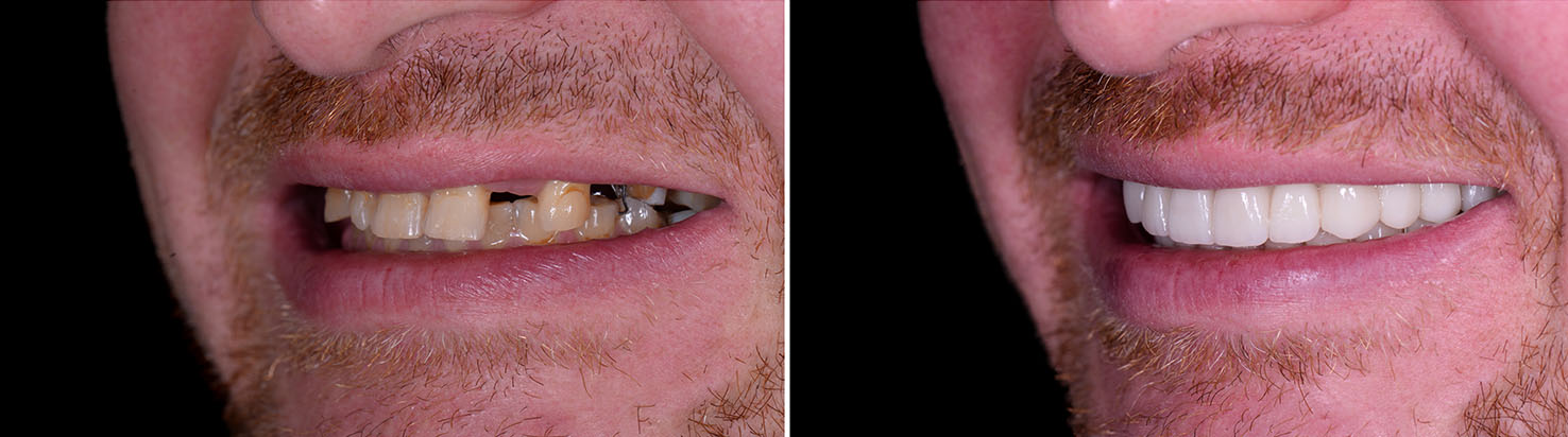 The image shows a person with two photos side by side  on the left, the person s teeth are yellowed, and on the right, their teeth have been whitened.