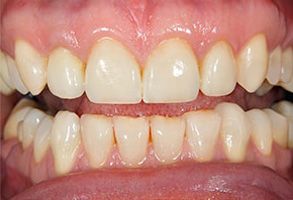 The image shows a close-up view of a person s mouth with crooked teeth and yellow stains, indicating poor oral hygiene.