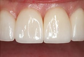 The image shows a close-up view of a person s teeth with a focus on a large gap between two front teeth, which are missing.
