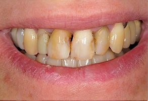 The image shows a person s mouth with yellowish teeth and gums.