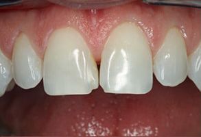 The image displays a close-up view of a person s teeth with a focus on a large gap between two front teeth, which are missing.